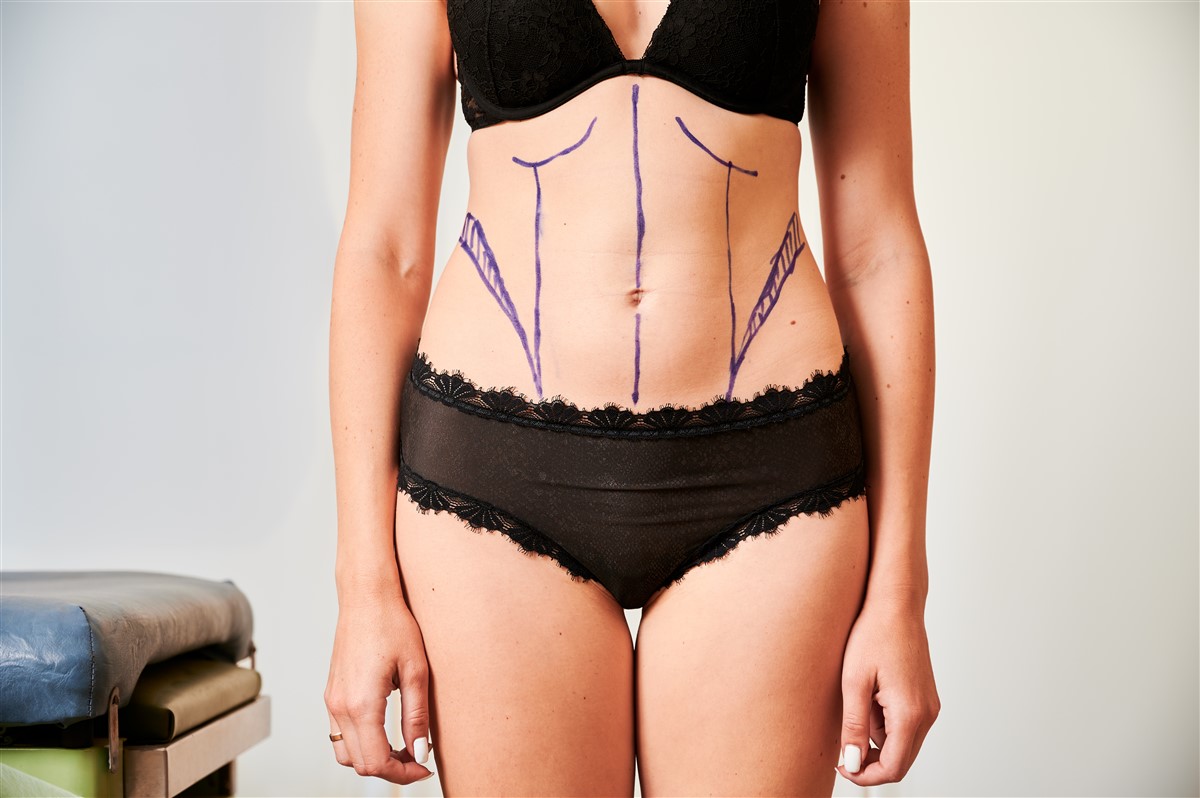 focus sur l'Abdominoplastie