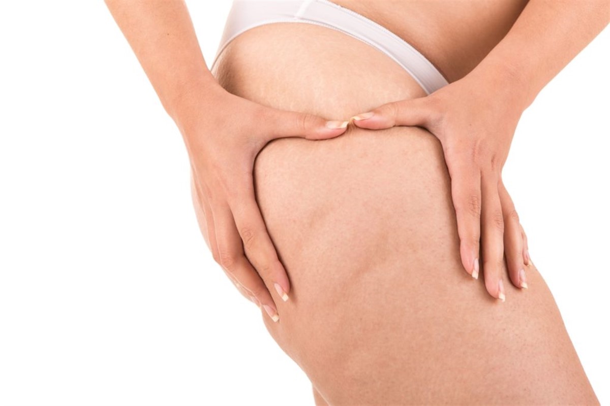 autour du lipoedème