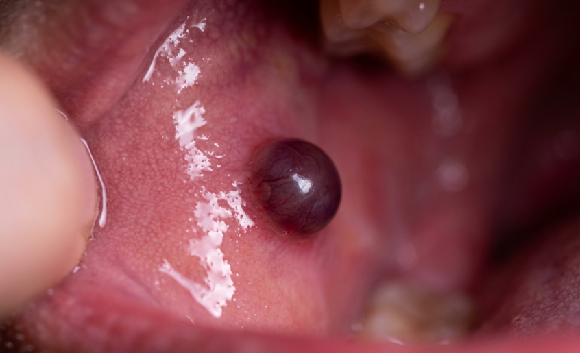 Cloque de sang dans la bouche