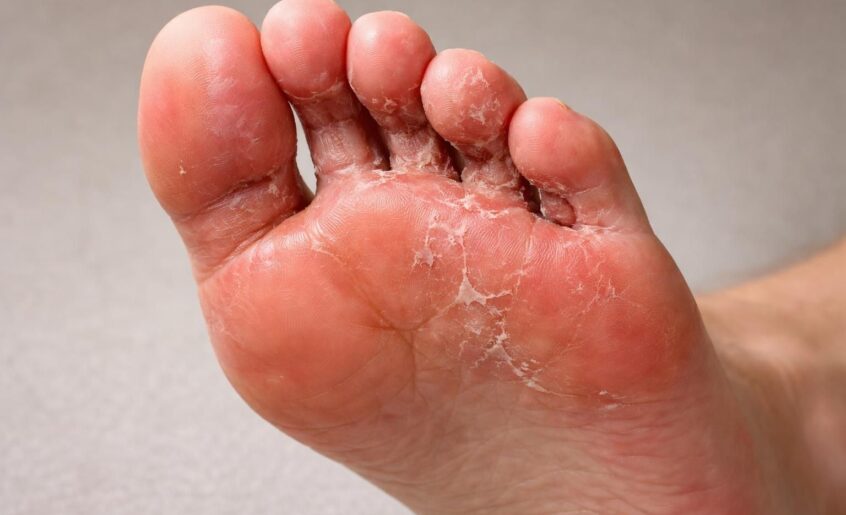 découvrez comment reconnaître le pied d’athlète, une infection fongique courante. apprenez à identifier les symptômes, prévenir la contamination et traiter efficacement cette affection cutanée.