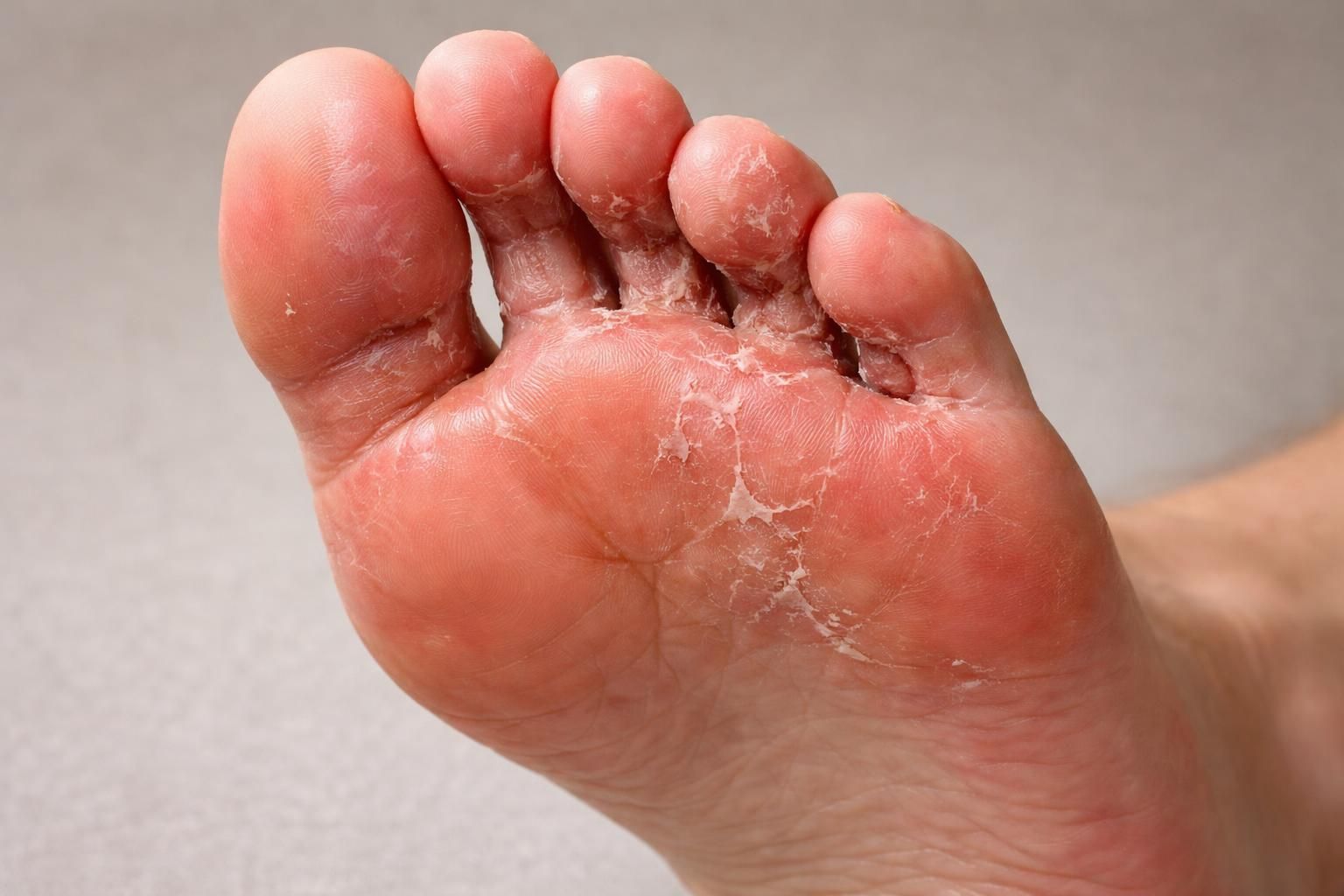 découvrez comment reconnaître le pied d’athlète, une infection fongique courante. apprenez à identifier les symptômes, prévenir la contamination et traiter efficacement cette affection cutanée.